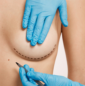 Breast Lift (Mastopexy)