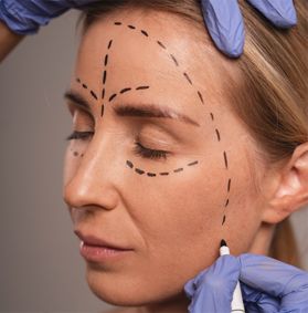 Facelift (Rhytidectomy)