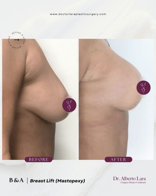 Breast Lift (Mastopexy)