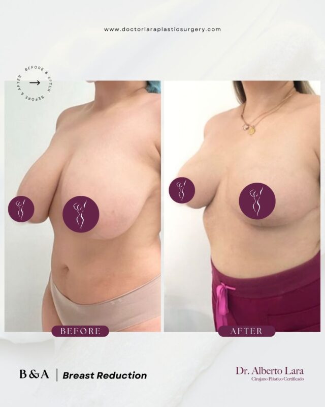 Breast Reduction