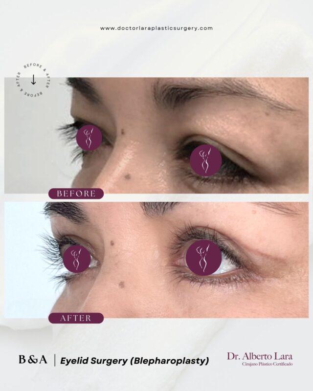 Eyelid Surgery (Blepharoplasty)