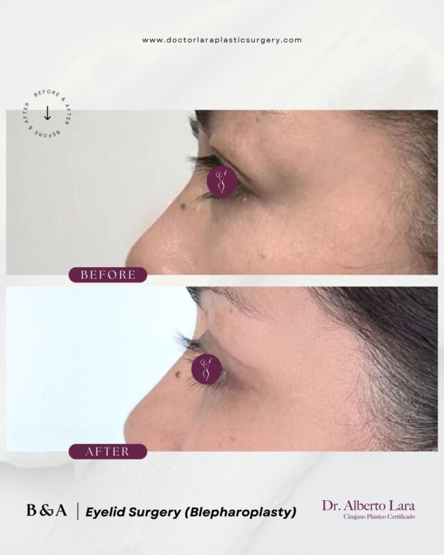 Eyelid Surgery (Blepharoplasty)