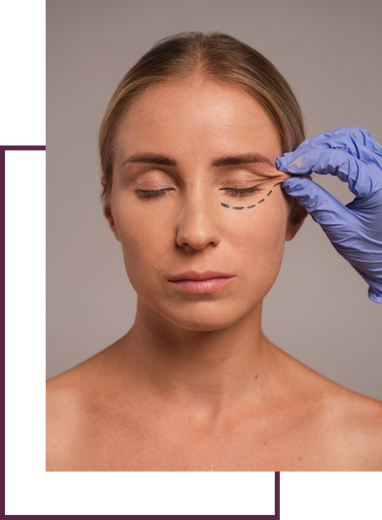 Eyelid Surgery (Blepharoplasty)