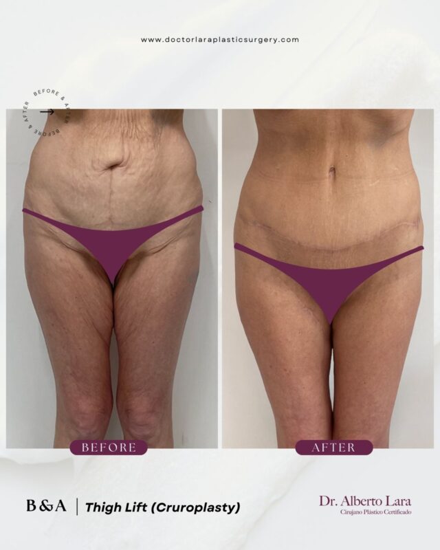 Thigh Lift (Cruroplasty)