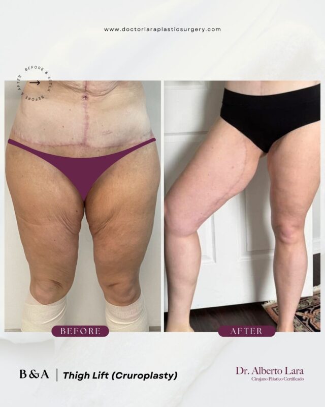 Thigh Lift (Cruroplasty)