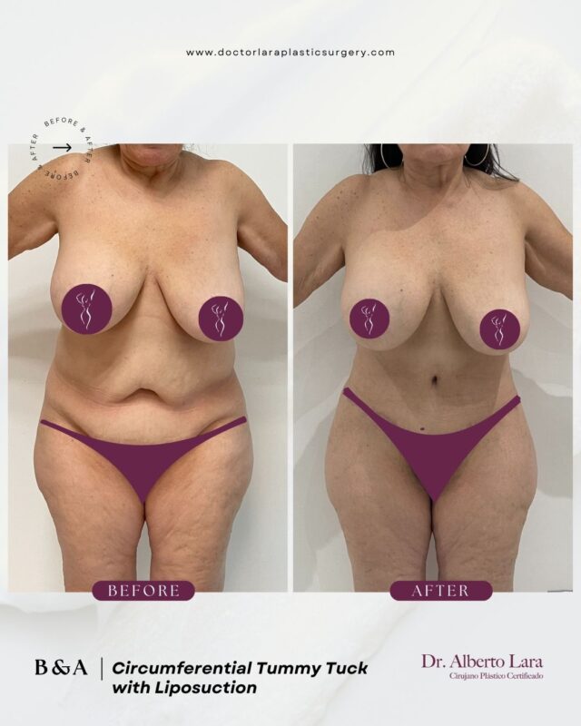 Tummy Tuck