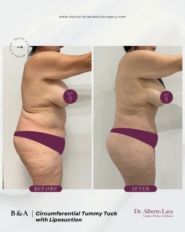 Tummy Tuck