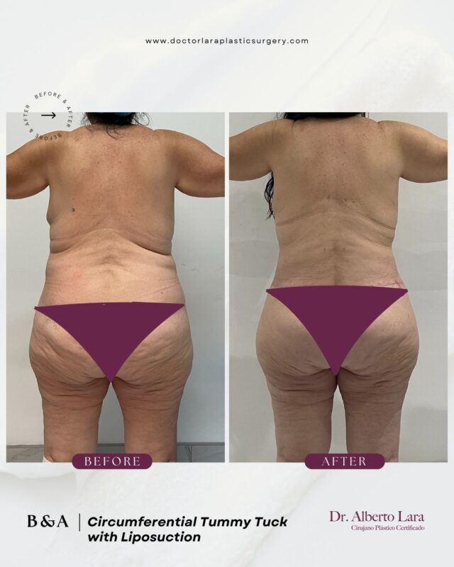 Tummy Tuck