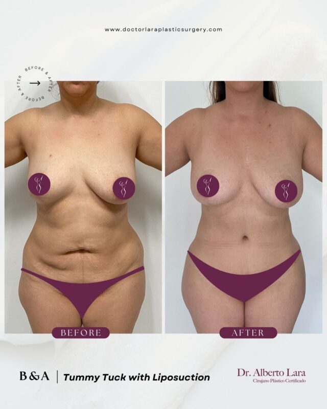 Tummy Tuck