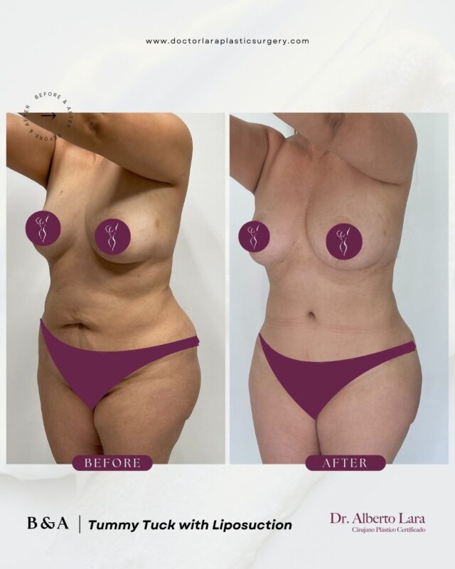 Tummy Tuck