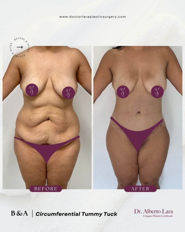 Tummy Tuck