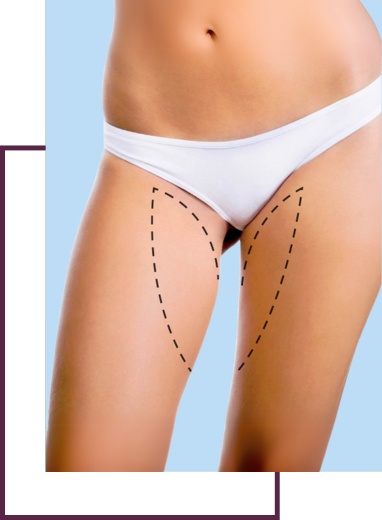 Thigh Lift (Cruroplasty)