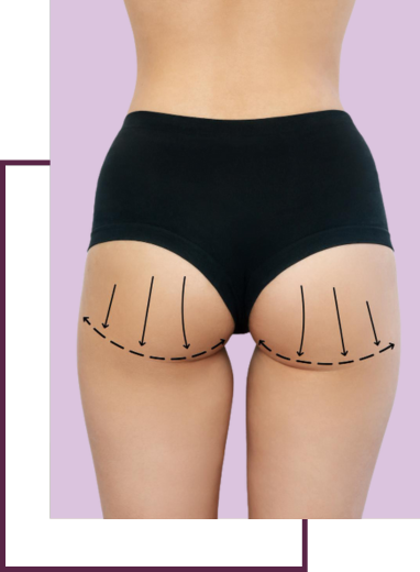Gluteal Implants (Butt Implants)