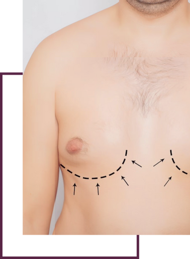 Gynecomastia Surgery