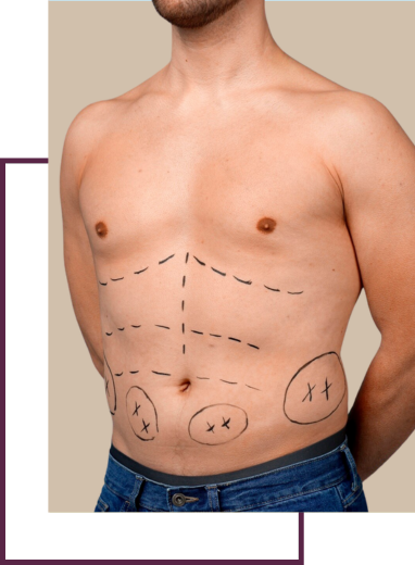 Upper Body Lift (Torsoplasty)