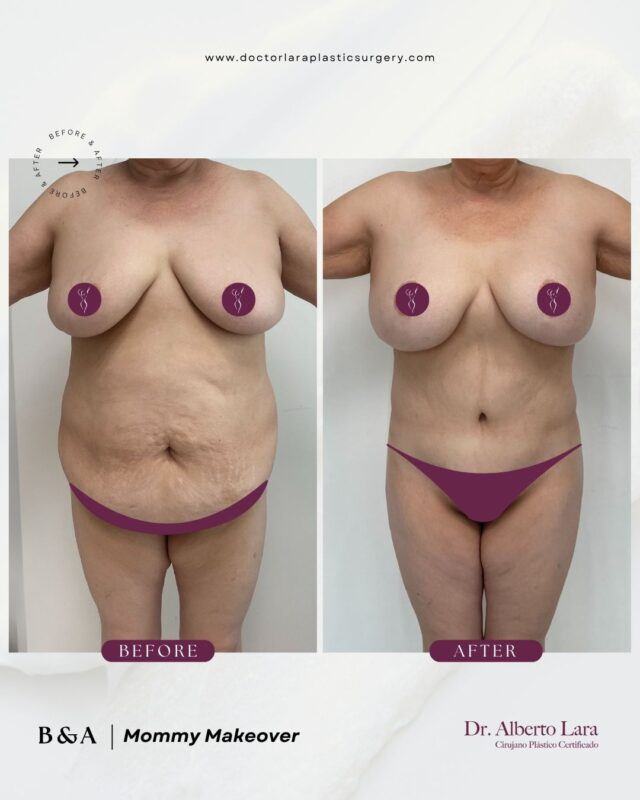 Before and after: Mommy Makeover