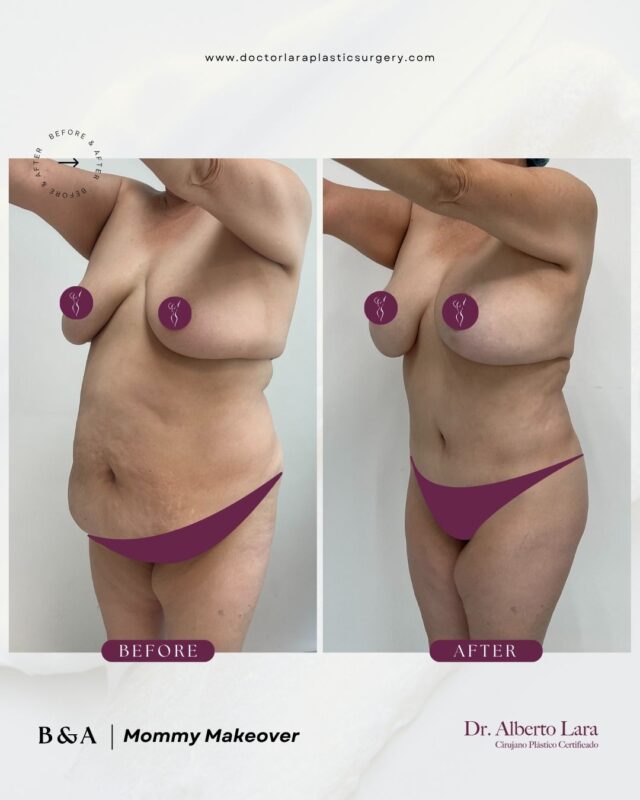 Before and after: Mommy Makeover