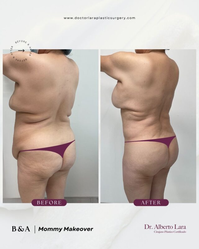 Before and after: Mommy Makeover