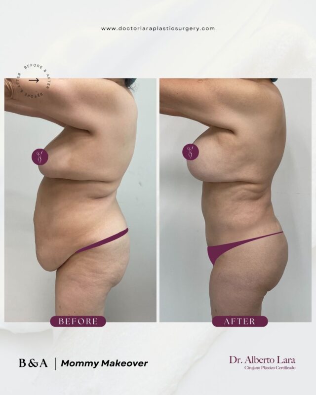 Before and after: Mommy Makeover