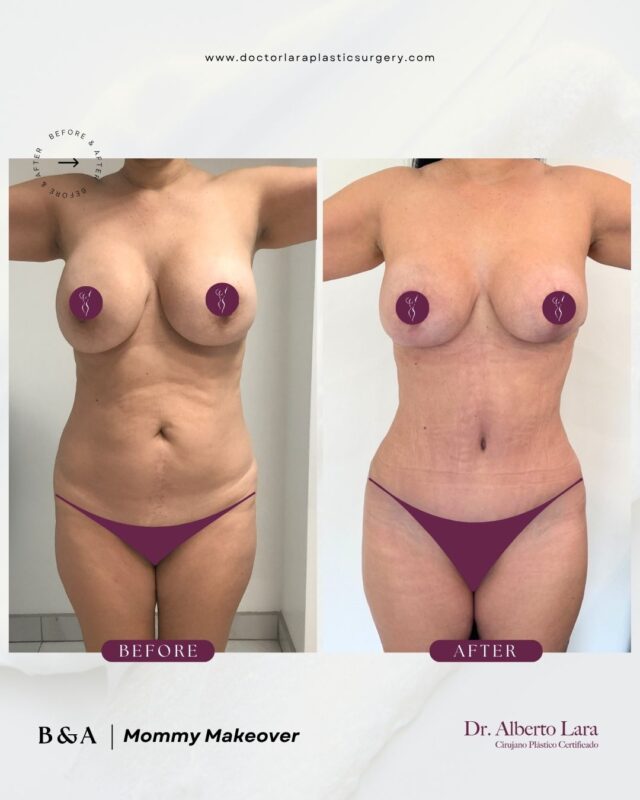 Before and after: Mommy Makeover