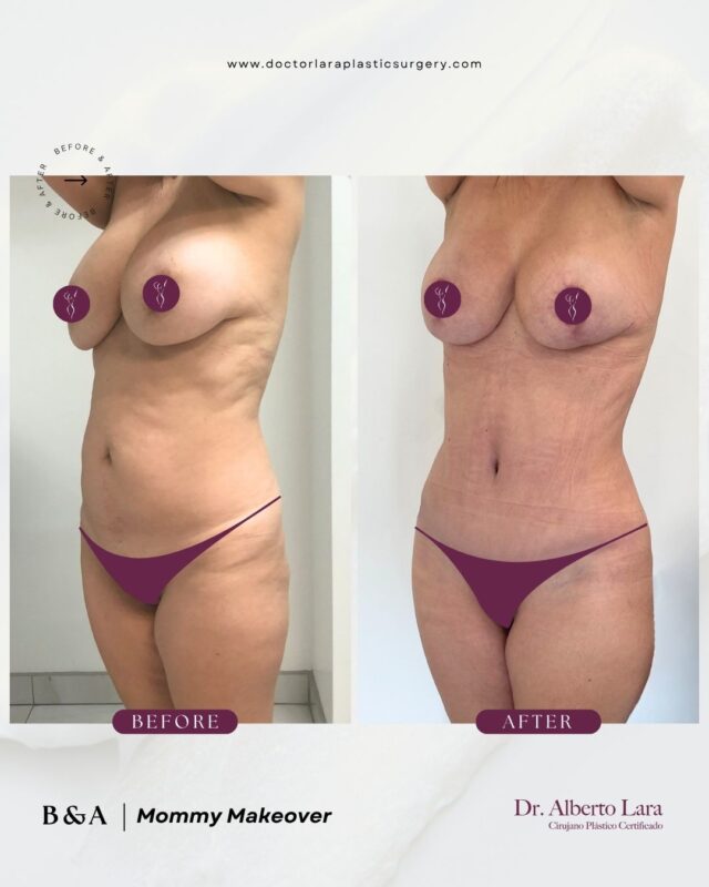 Before and after: Mommy Makeover