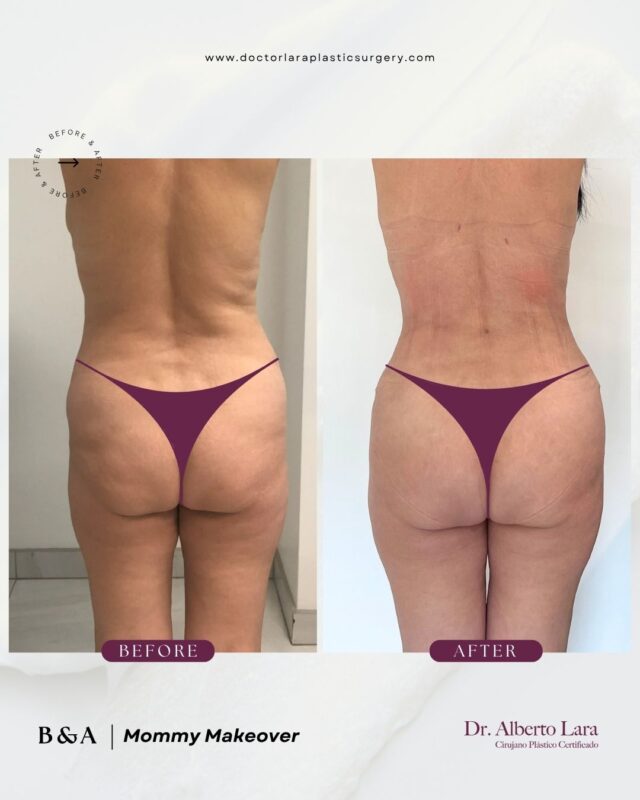 Before and after: Mommy Makeover