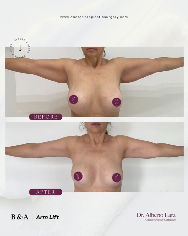 Arm Lift (Brachioplasty)