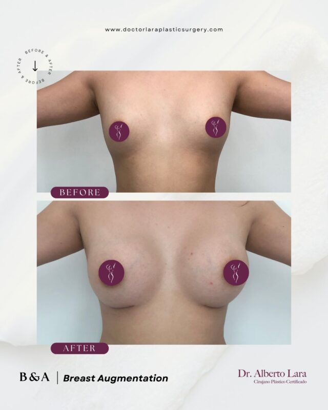 Breast Augmentation with Implants