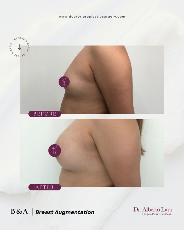 Breast Augmentation with Implants