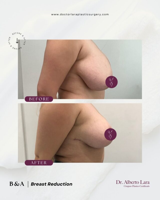 Breast Reduction