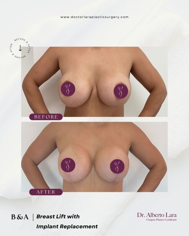 Breast Lift