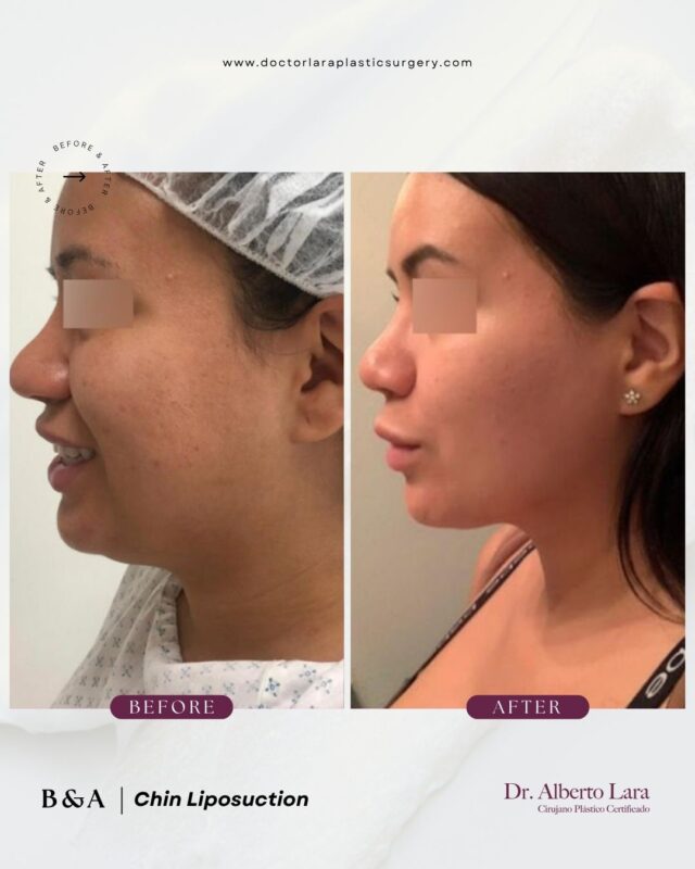 Chin Liposuction