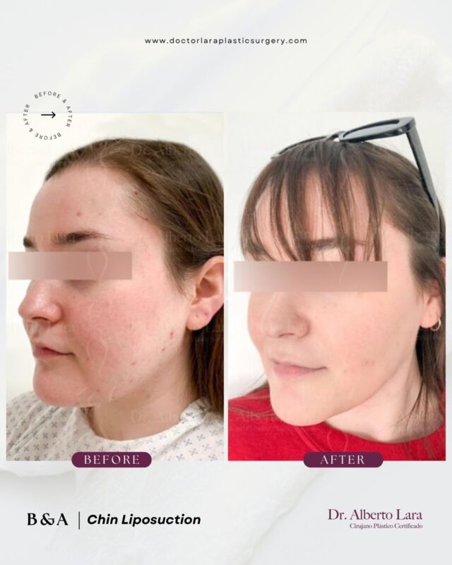 Chin Liposuction