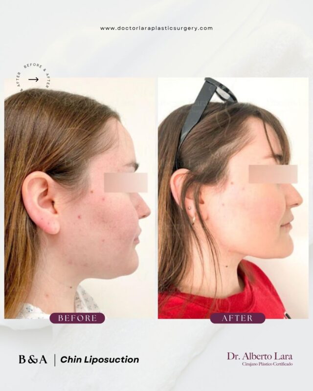 Chin Liposuction