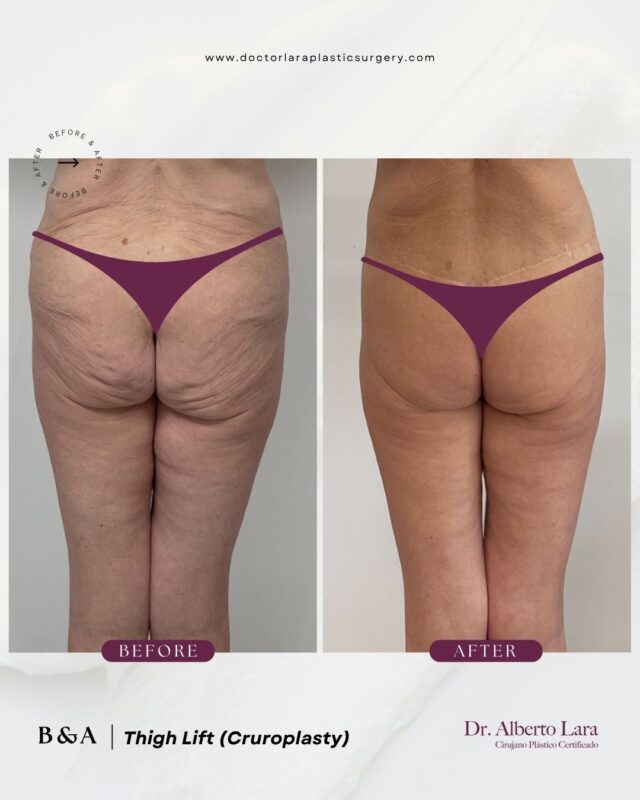 Thigh Lift (Cruroplasty)