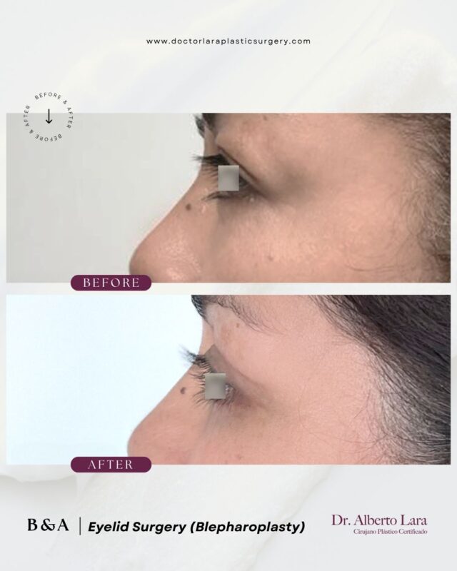Eyelid Surgery (Blepharoplasty)
