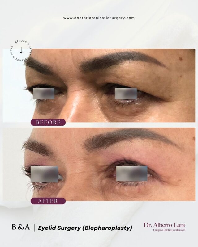 Eyelid Surgery (Blepharoplasty)