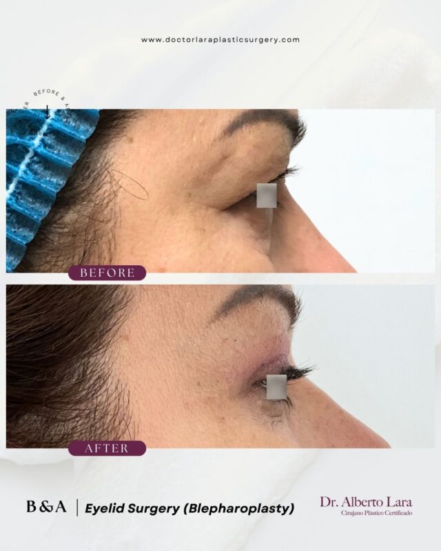 Eyelid Surgery (Blepharoplasty)