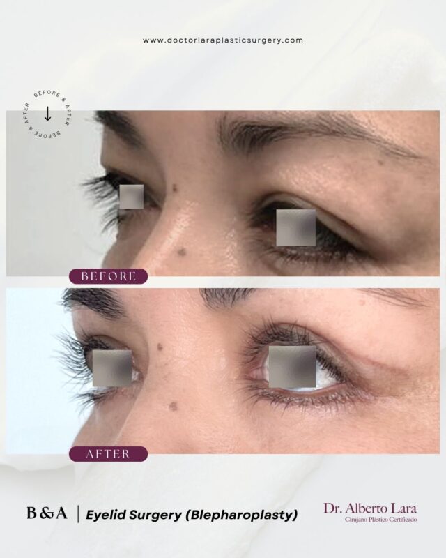 Eyelid Surgery (Blepharoplasty)