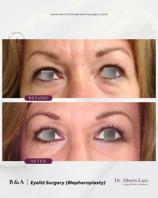 Eyelid Surgery (Blepharoplasty)