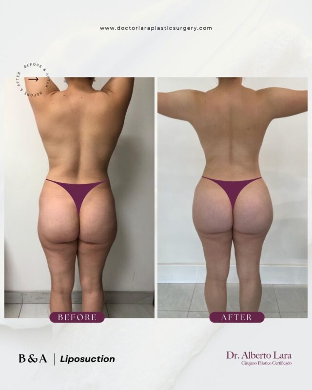 Liposuction
