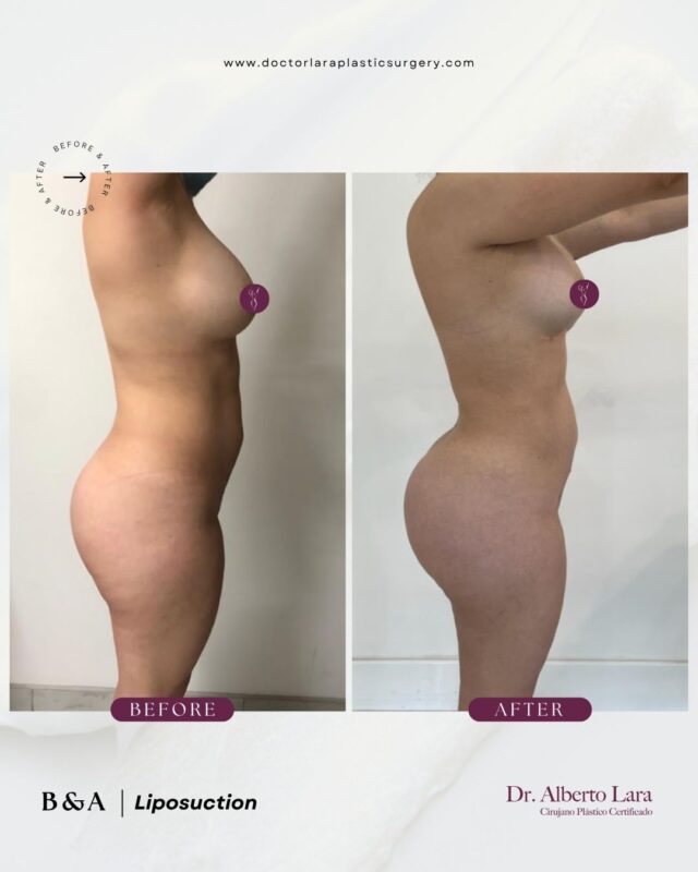 Liposuction