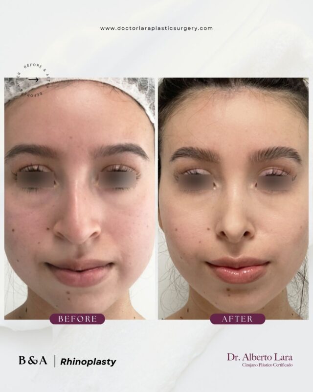 Rhinoplasty