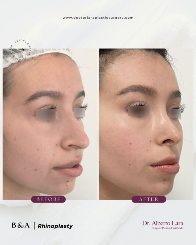 Rhinoplasty