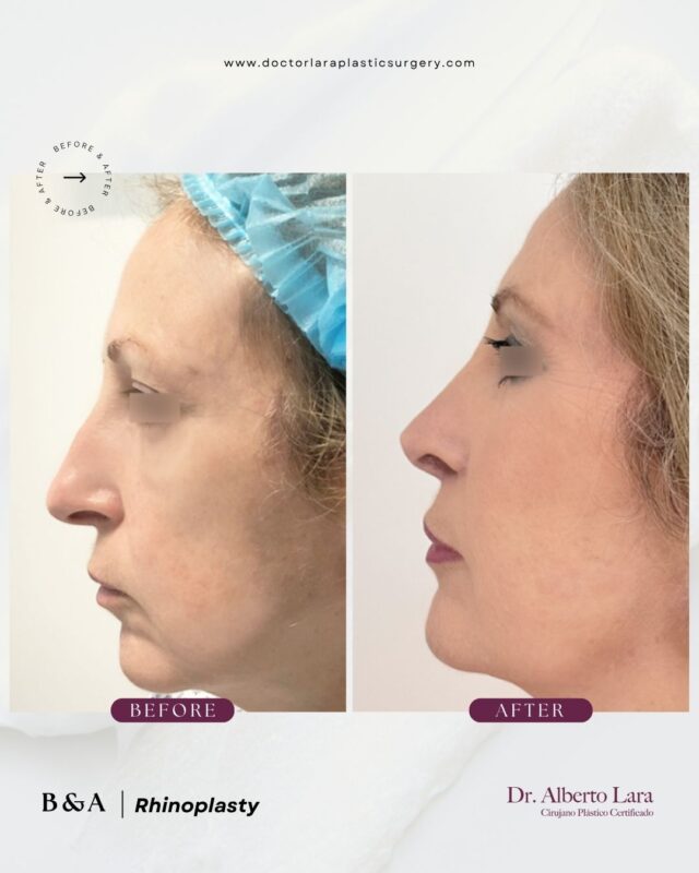 Rhinoplasty