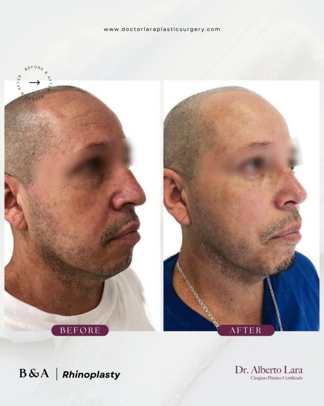 Rhinoplasty