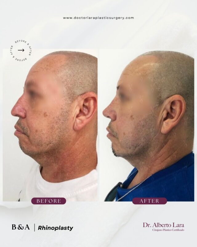 Rhinoplasty