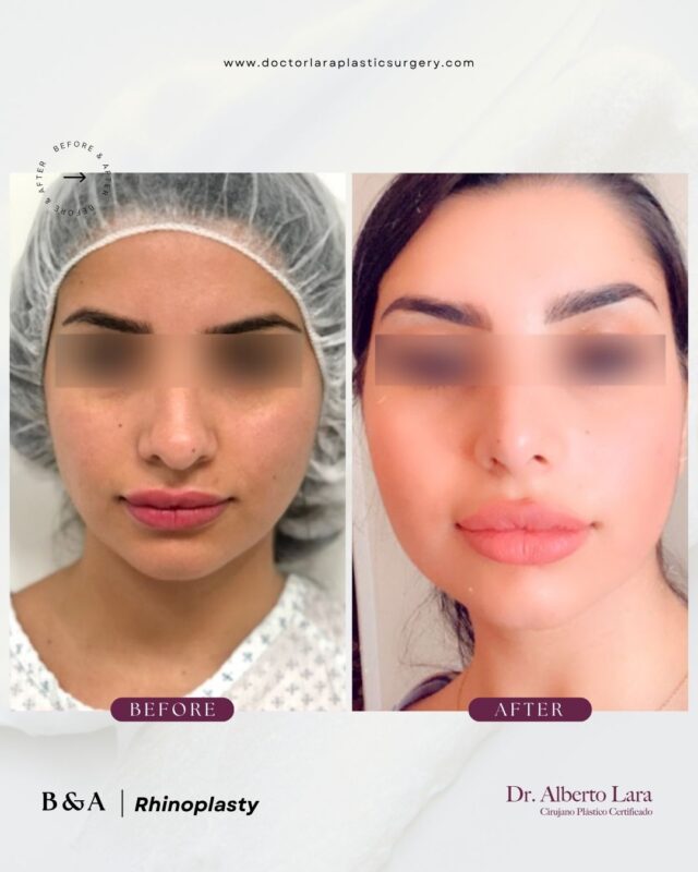 Rhinoplasty