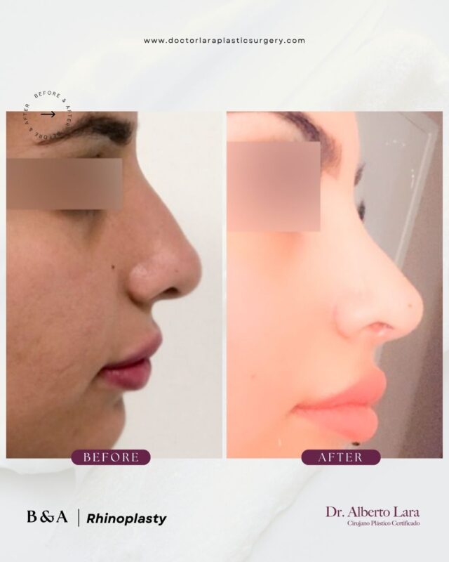 Rhinoplasty