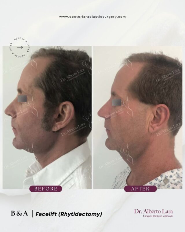 Facelift (Rhytidectomy)